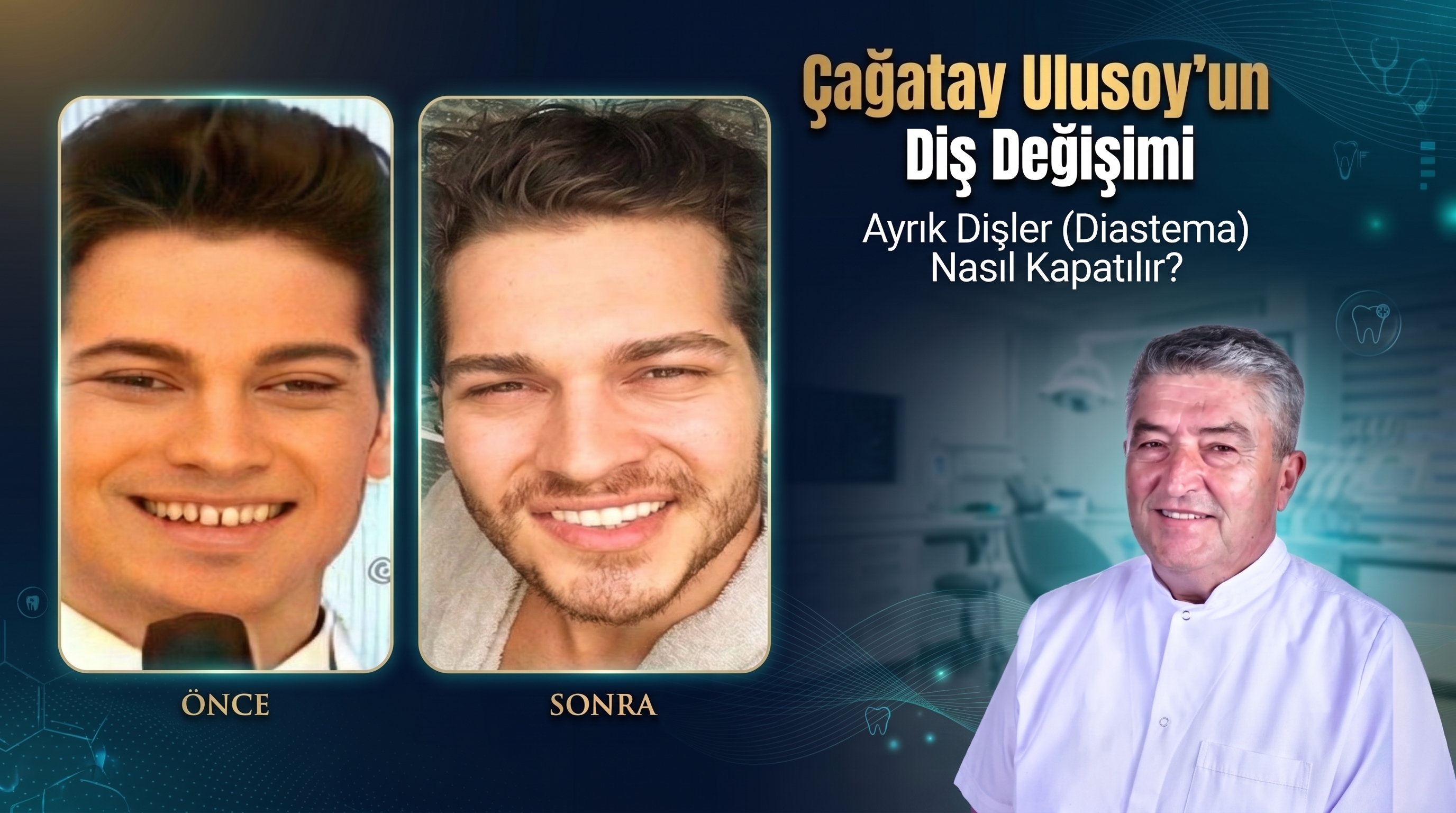 Çağatay Ulusoy'un Diş Değişimi: Ayrık Dişler (Diastema) Nasıl Kapatılır?